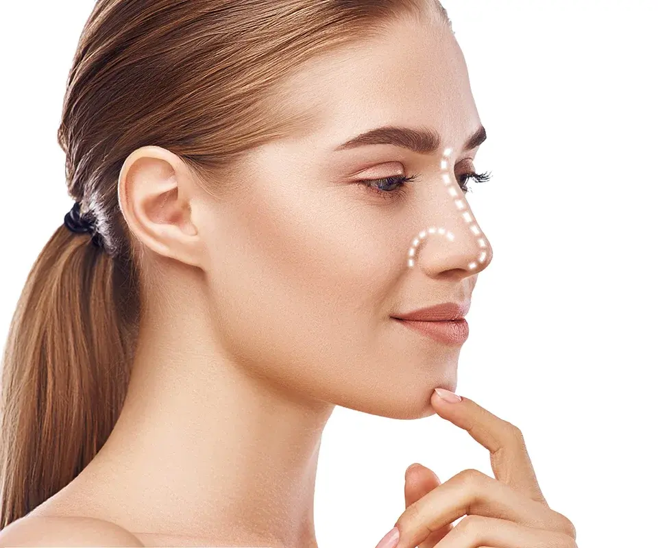 Rhinoplasty